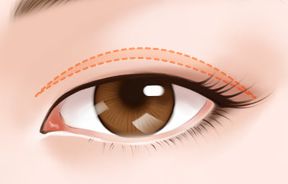 上海激光祛痣哪家醫(yī)院效果最好？