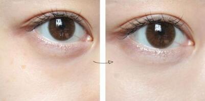 專家解讀杜園園眼袋修復術(shù)，醫(yī)生背景介紹、就診醫(yī)院信息及療效科普