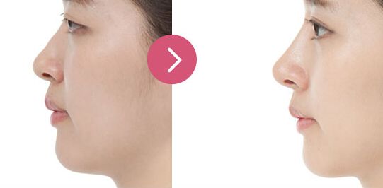 揚(yáng)州私密整形哪家好？專業(yè)推薦！