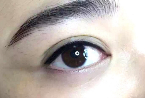 石正華雙眼皮修復(fù)療效，費(fèi)用查詢，重慶美萊do眼專家全面闡述