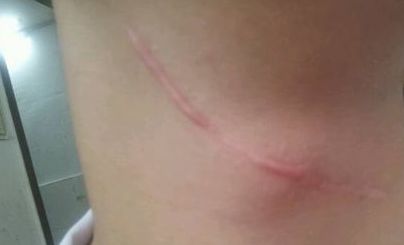 重慶祛除胎記哪家醫(yī)院好-重慶市專業(yè)胎記治療醫(yī)院推薦