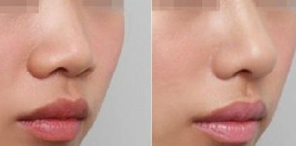 深圳修復(fù)雙眼皮哪家醫(yī)院好？淺談深圳雙眼皮修復(fù)專家排行榜