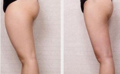 商丘做雙眼皮去哪家好？選擇最適合自己的雙眼皮整形醫(yī)院