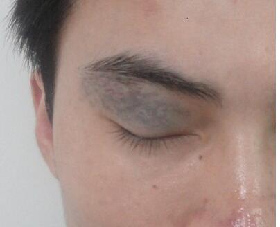 尹琳磨骨手術(shù)評(píng)價(jià)：醫(yī)生實(shí)力超群，效果驚艷！