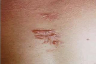 成都祛疤痕效果好的醫(yī)院有哪些？