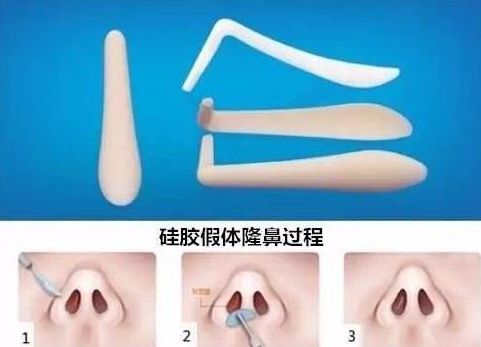 上海哪家醫(yī)院祛斑去痣好？專家?guī)懔私庾钸m合你的祛斑去痣方法！