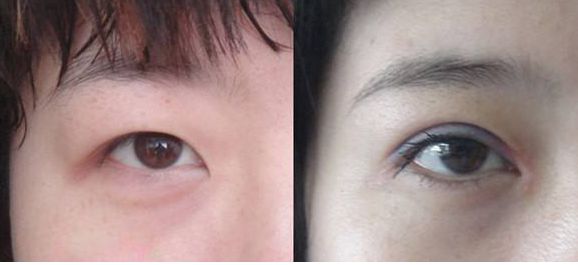 上海市激光修復(fù)痘坑效果如何？哪家醫(yī)院技術(shù)更好？