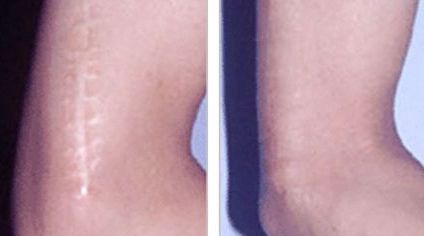 哈爾濱哪家醫(yī)院去除痘痘增生效果好，推薦給大家！