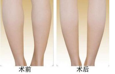 李闖隆鼻效果對(duì)比：神奇改變顏值，素顏?zhàn)孕胖責(zé)ㄇ啻海?/>
                                </a>
                                <h4><a href=