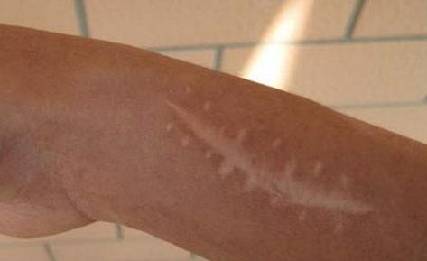 南京哪家醫(yī)院的疤痕修復(fù)效果最佳？