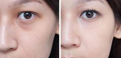 北京楊鍇做雙眼皮手術(shù)有哪些收費(fèi)情況？手術(shù)案例一覽