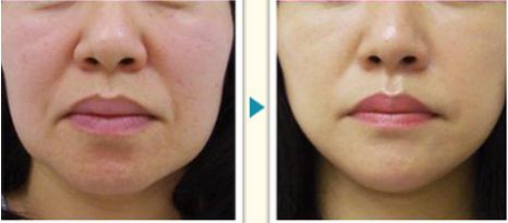 溫州激光祛痘醫(yī)院排行榜，哪家專業(yè)好評多