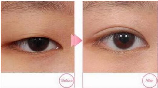 寧波哪家醫(yī)院做韓式雙眼皮效果好？