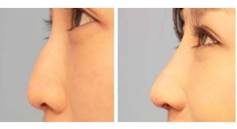 大連瑞和醫(yī)療美容醫(yī)院受歡迎嗎？楊檸澤做雙眼皮效果怎樣？真實(shí)網(wǎng)友體驗(yàn)來(lái)了解！