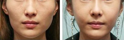 重慶雙眼皮整形醫(yī)院評價如何？哪家信譽好？