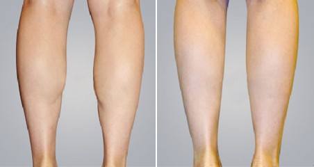 2023江門(mén)自體脂肪墊鼻基底口碑榜前十強(qiáng)的專(zhuān)家(周俊、黃銀嬌、楊嬌技術(shù)專(zhuān)業(yè)、價(jià)格便宜)