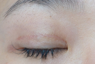 2023北京愛貝芙注射填充去痘疤醫(yī)生前10強排行(劉健、解永學、葉宇盤點實力派，特點對比！)