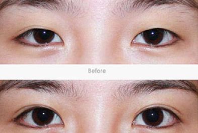 上海雙眼皮手術(shù)哪家醫(yī)院好？選擇哪家醫(yī)院最關(guān)鍵