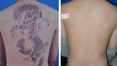 怎樣修復(fù)鄭荃疤痕，讓人滿意？