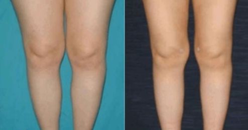 包頭有哪些靠譜的醫(yī)院能做好雙眼皮切開(kāi)手術(shù)？