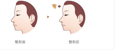 上海翡立思醫(yī)療陳立彬：無痛吸脂撇開隱患，告別粗腿不再是夢