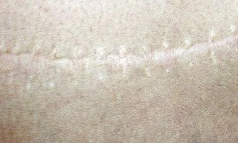 聊城玻尿酸隆鼻哪家好？專業(yè)醫(yī)生推薦幫助您選擇