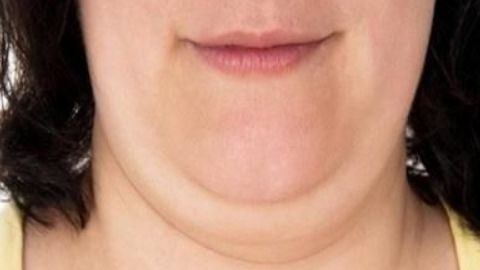 吳佳君醫(yī)生拉皮技術獨步一時，值得信賴嗎？費用如何計算？