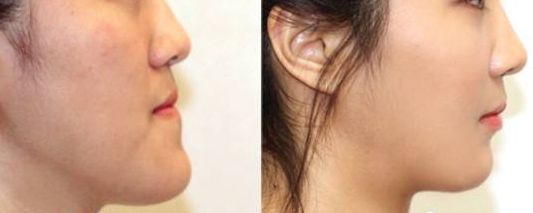 蚌埠雙眼皮哪家做的好？選擇雙眼皮手術(shù)醫(yī)院，找到最靠譜的專家！