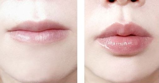 南京哪家醫(yī)院治療黃褐斑效果好？