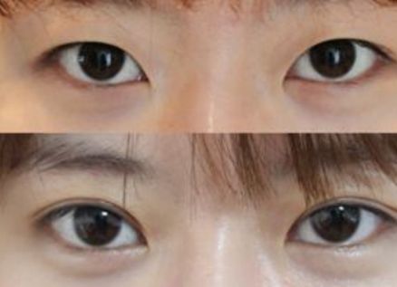 杭州去咖啡斑好的醫(yī)院有哪些？