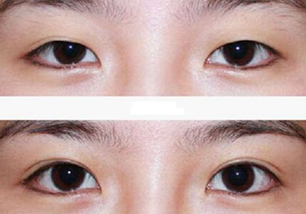 北京哪家激光祛痘醫(yī)院好？選擇正規(guī)醫(yī)療機構，實力專家團隊等你來解答