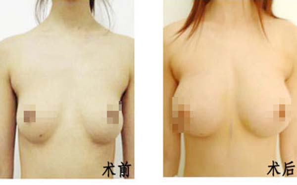 朱海杰鼻部整形效果如何？醫(yī)生評(píng)價(jià)+就診醫(yī)院匯總+價(jià)格信息參考