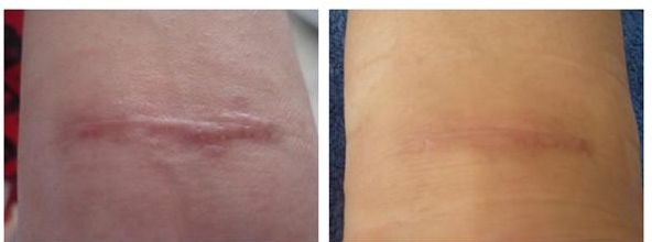 廣州治疤痕醫(yī)院專家推薦，哪家治疤痕效果好？