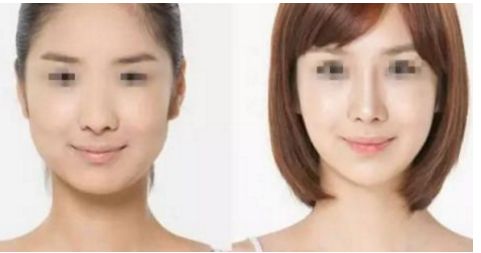 威寧隆胸手術(shù)效果如何？術(shù)后持久無(wú)需擔(dān)心！