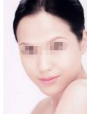 眼袋內(nèi)切手術(shù)后的注意事項