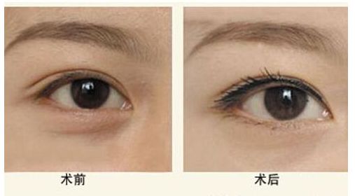 隆鼻手術(shù)后修復(fù)時間及禁忌事項解析