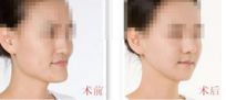 隆鼻手術(shù)平衡術(shù)：讓你的鼻子立體感更強(qiáng)