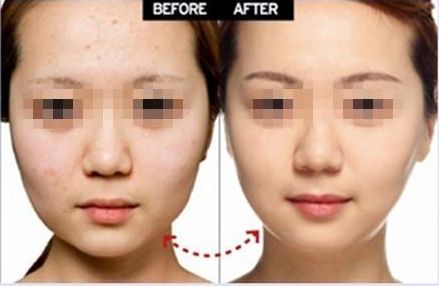 開外眼角手術：提升臥蠶、增大眼睛，效果有多好？