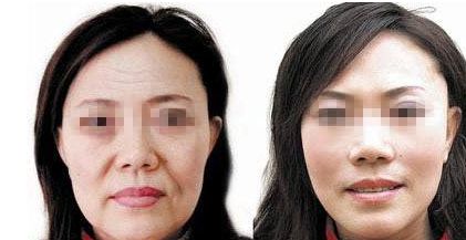 下頜整形常見技術及優(yōu)缺點解析