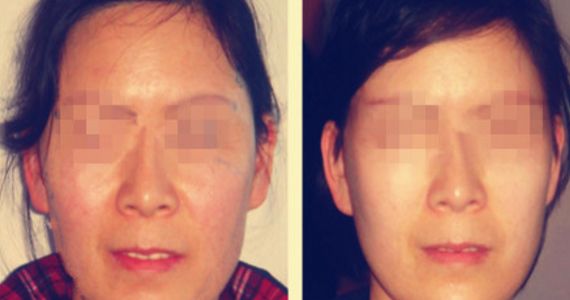 opt光子嫩膚費(fèi)用及價(jià)格查詢?cè)斀?，了解opt光子嫩膚真實(shí)價(jià)格與口碑評(píng)價(jià)