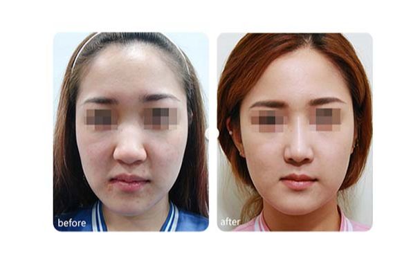 7d聚拉提果真的那么神奇嗎？挽救肌膚年齡，還讓你重獲青春之美！