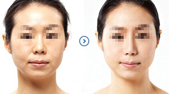 想要塑造完美鼻型？了解全肋骨隆鼻手術嗎？