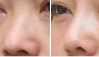 湖南雙眼皮修復(fù)，成功率備受矚目