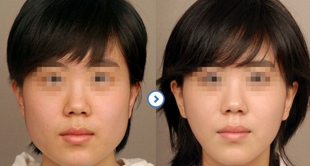 鼻部假體整形：探尋安全有效的修復方法