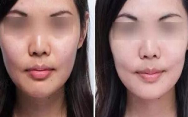 35歲采用超聲療程好還是熱瑪吉更好？匿名評測揭秘！