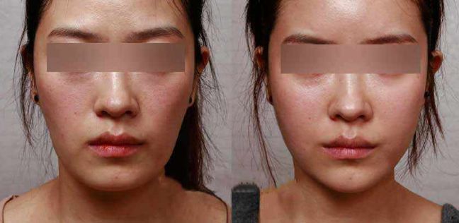 眼袋手術后效果持續(xù)多久？解析專家分享