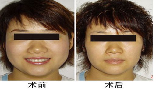 咬肌切除手術(shù)后對面部功能是否會受影響？