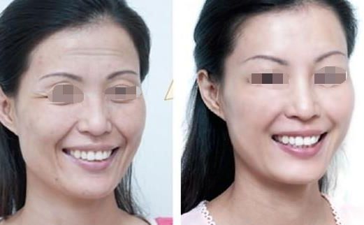 面部吸脂瘦臉效果如何？達(dá)到自然效果的關(guān)鍵是什么