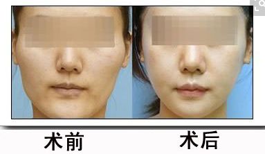 鼻骨矯正對(duì)外貌有何影響？矯正費(fèi)用合理嗎？