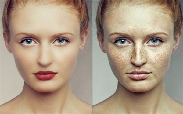 透明質(zhì)酸隆鼻：持續(xù)效果與固定時(shí)間詳解